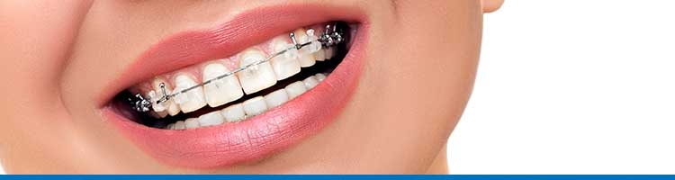 braces