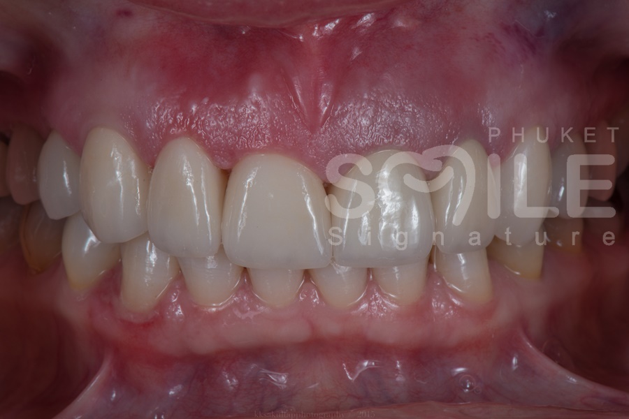 Phuket Tooth Crowns