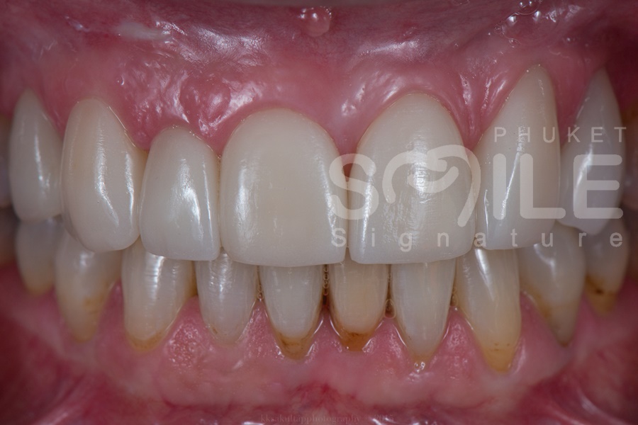 Porcelain Crown Phuket