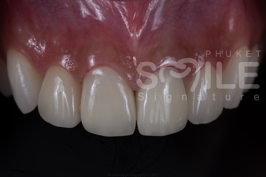 Phuket Ceramic Crowns