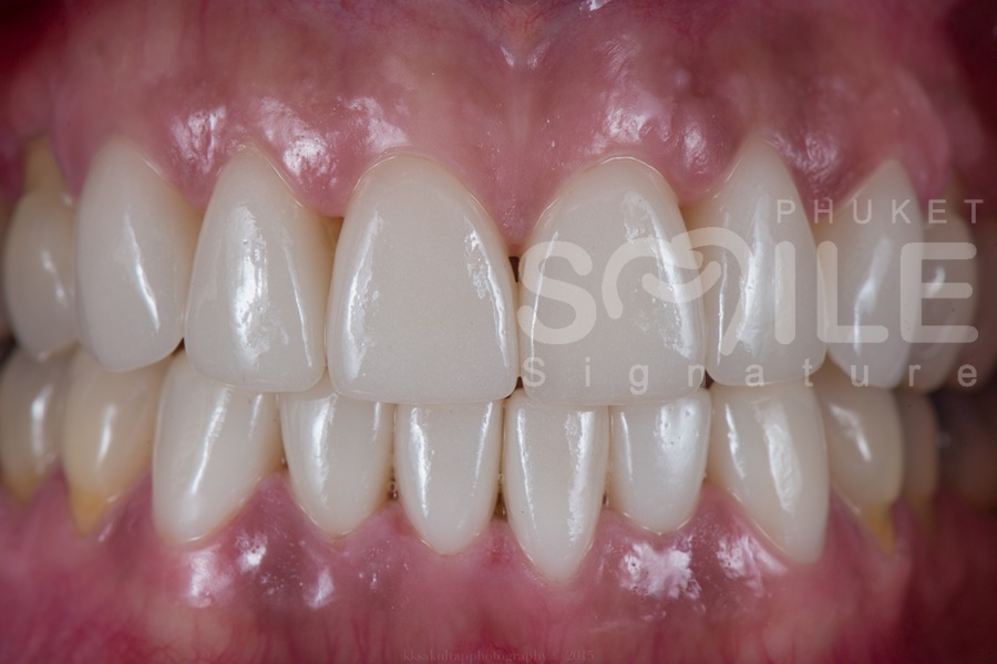 Dental Veneers Phuket