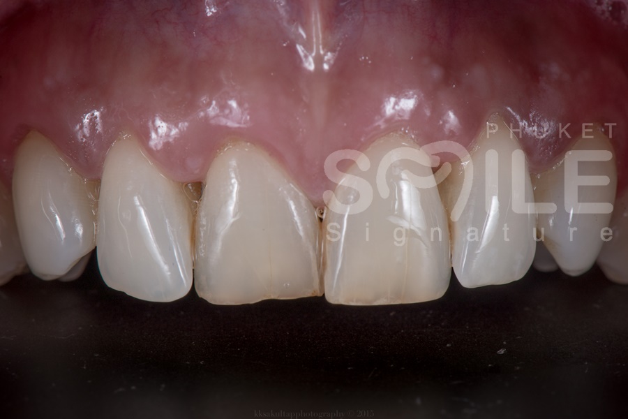 Dental Veneer Phuket