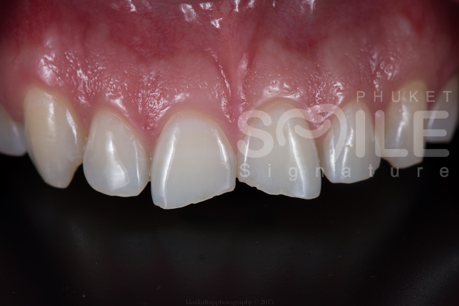Phuket Dental Veneer