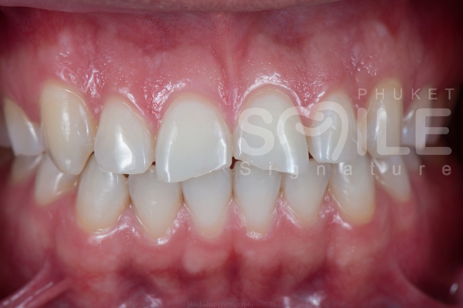 Dental makeover Phuket