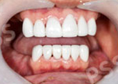 teeth crowns bridges
