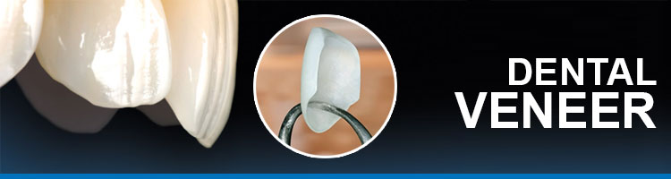 dental veneer
