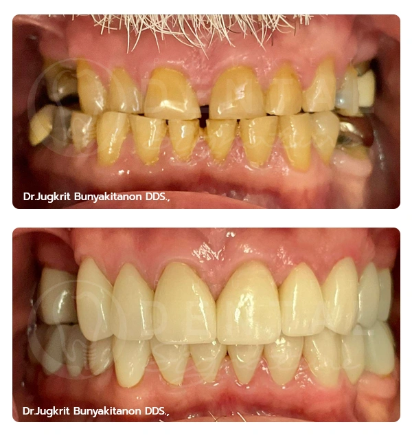Crowns Veneers