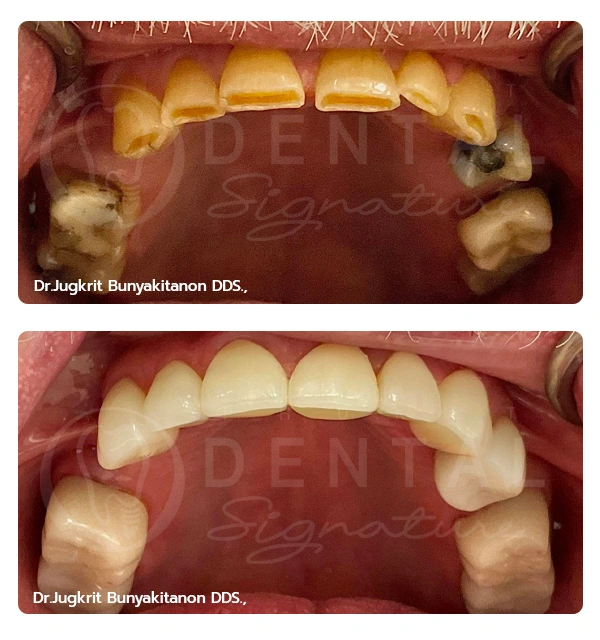 Crowns Veneers