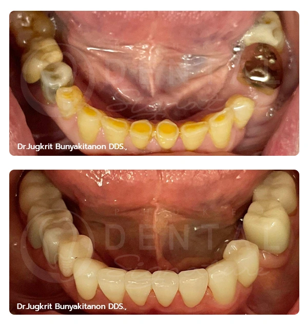 Crowns Veneers
