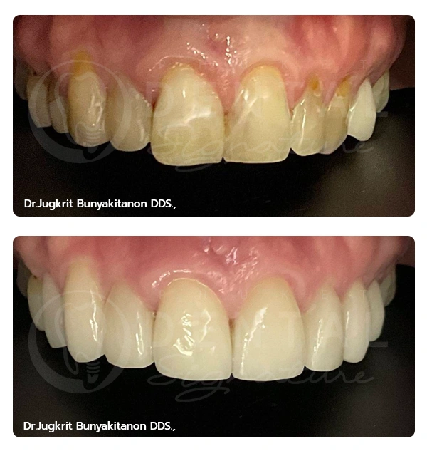 Crowns Veneers